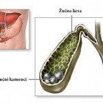 Kamenac-u-zucnoj-kesi