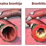 bronhitis