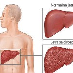 ciroza-jetre