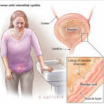 cystitis