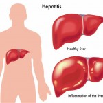 hepatitis