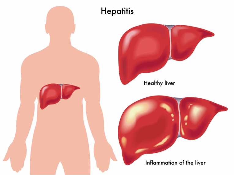 hepatitis s bolovima u zglobovima i mišićima