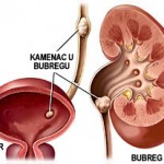 kamenac_u_bubregu