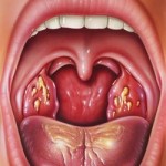 tonzilitis